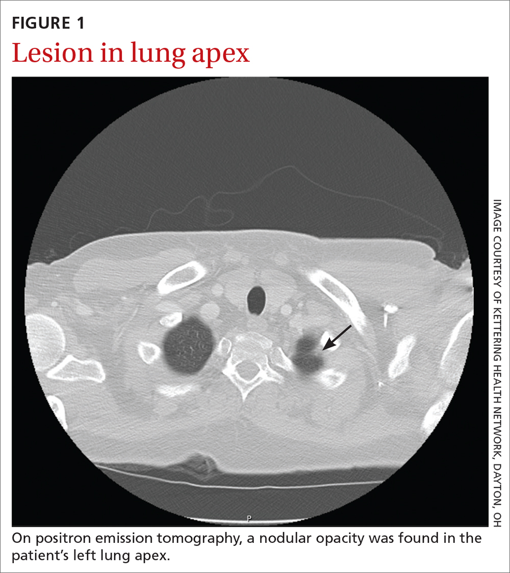 Lesion in lung apex