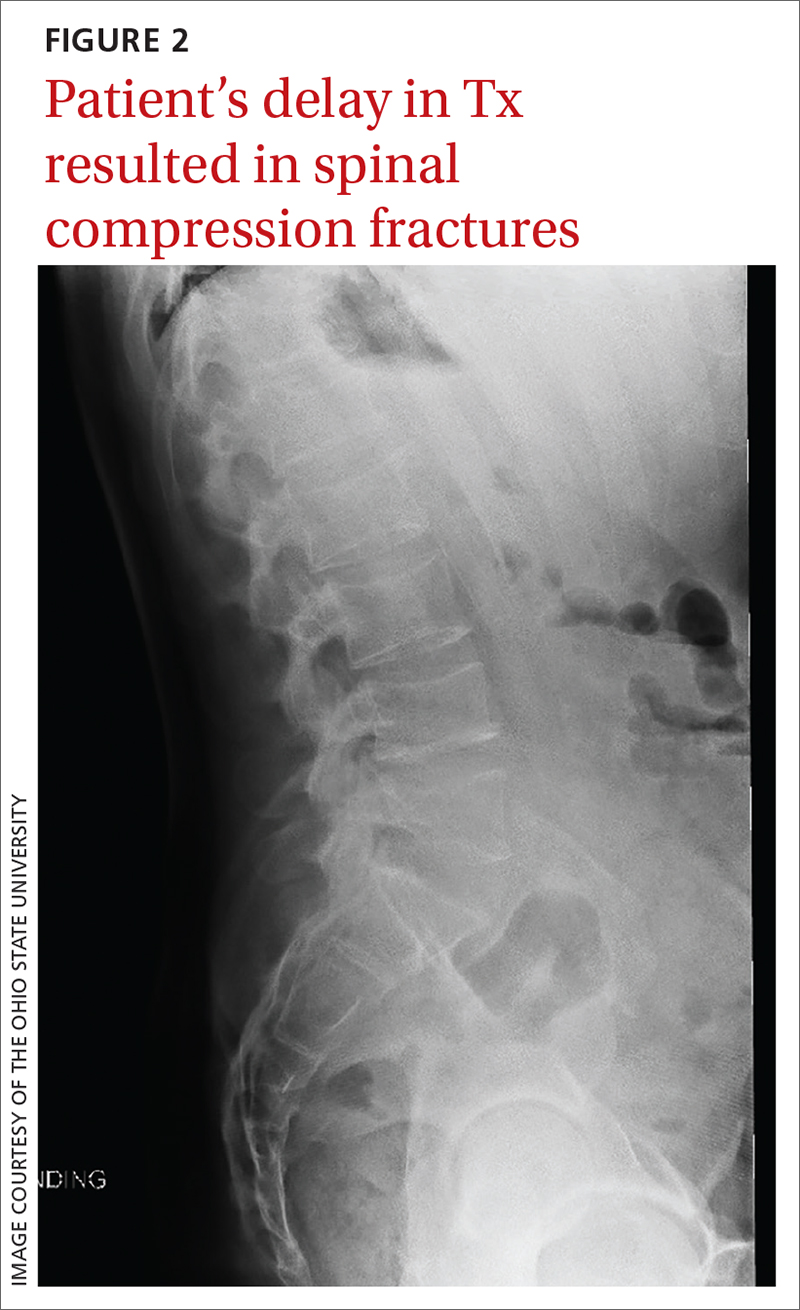 Patient’s delay in Tx resulted in spinal compression fractures