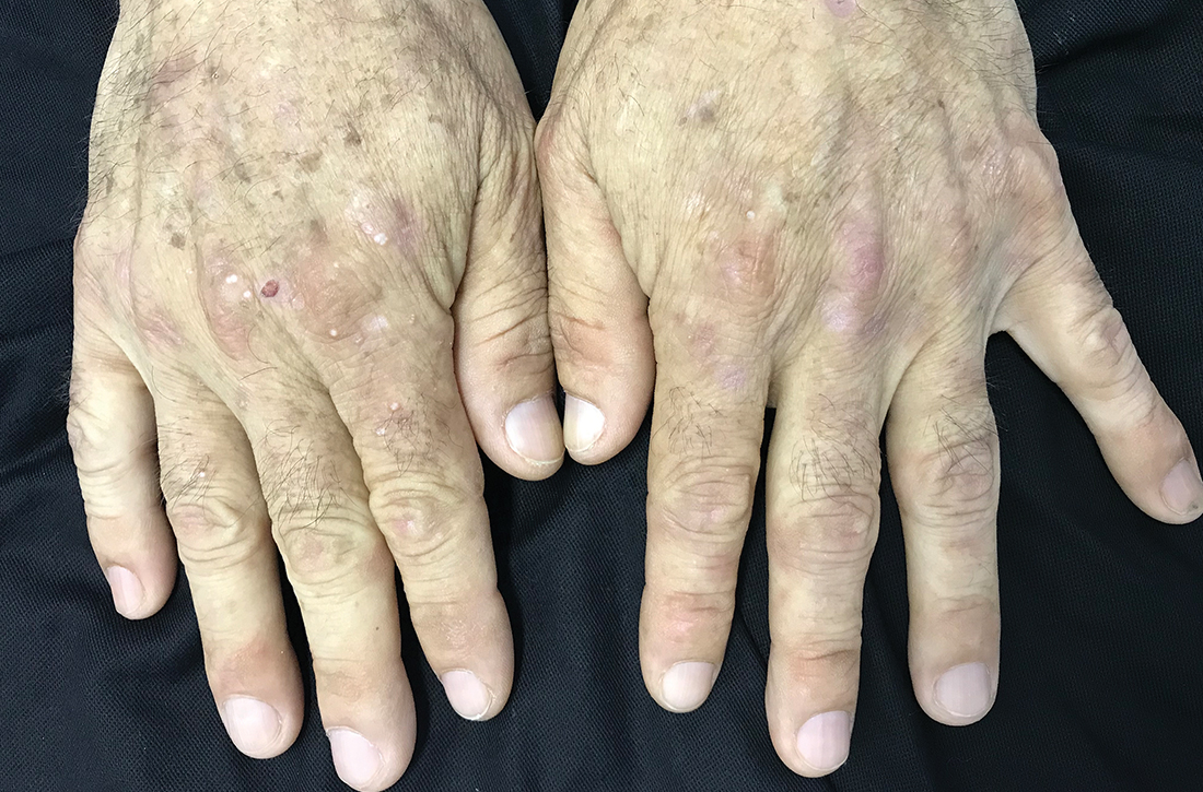 The patient had milium cysts, as well as small, shallow erosions, on the dorsal surface of both hands