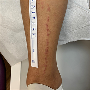 Linear leg rash