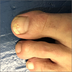 Toenail trauma