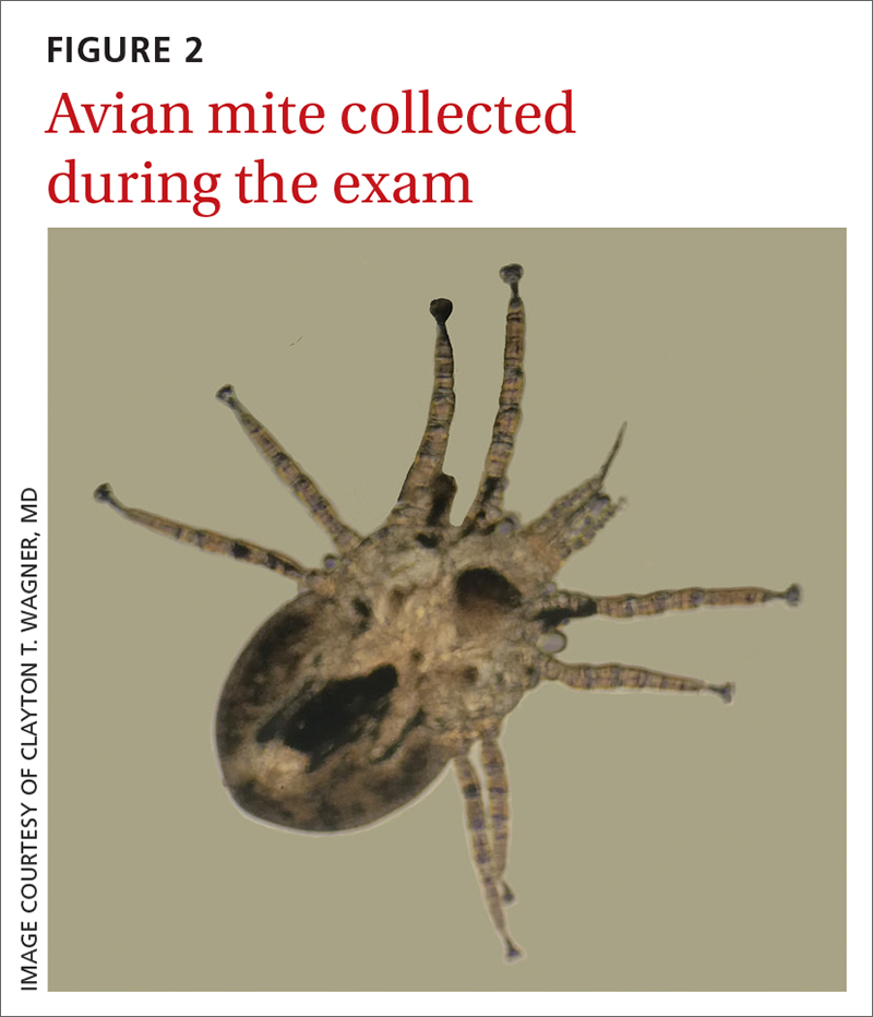 Avian mite collected during the exam