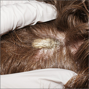 Scalp plaque