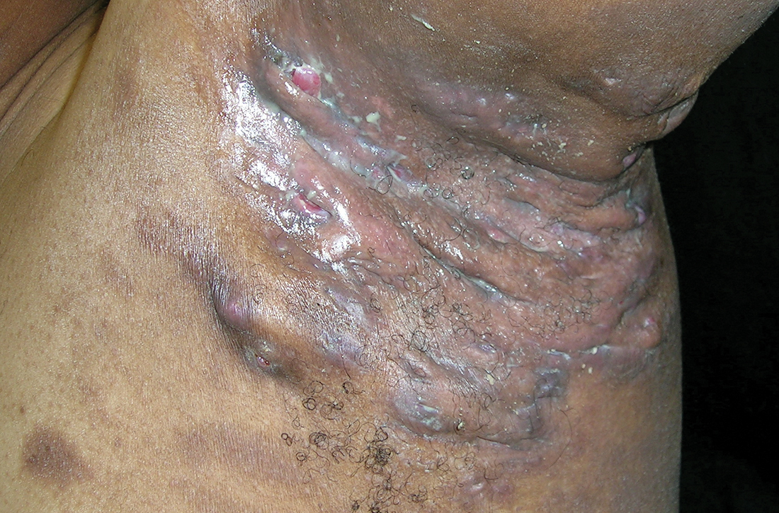 Severe longstanding hidradenitis suppurativa (Hurley stage III) with architectural changes, ropy scarring, granulation tissue, and purulent discharge in the axilla of a 35-year-old Black man.