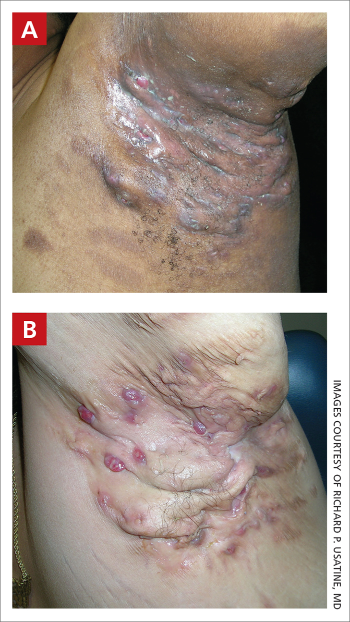 Hidradenitis suppurativa