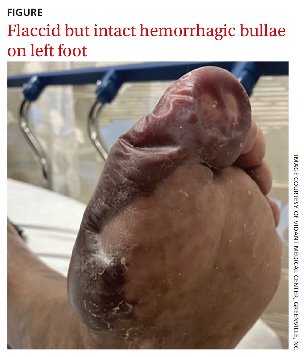 Flaccid but intact hemorrhagic bullae on left foot