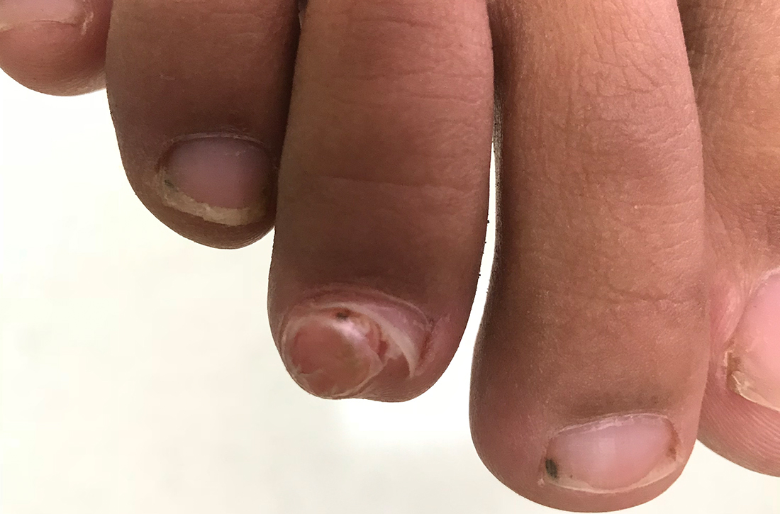 Nodule on third toe leading to nail dystrophy