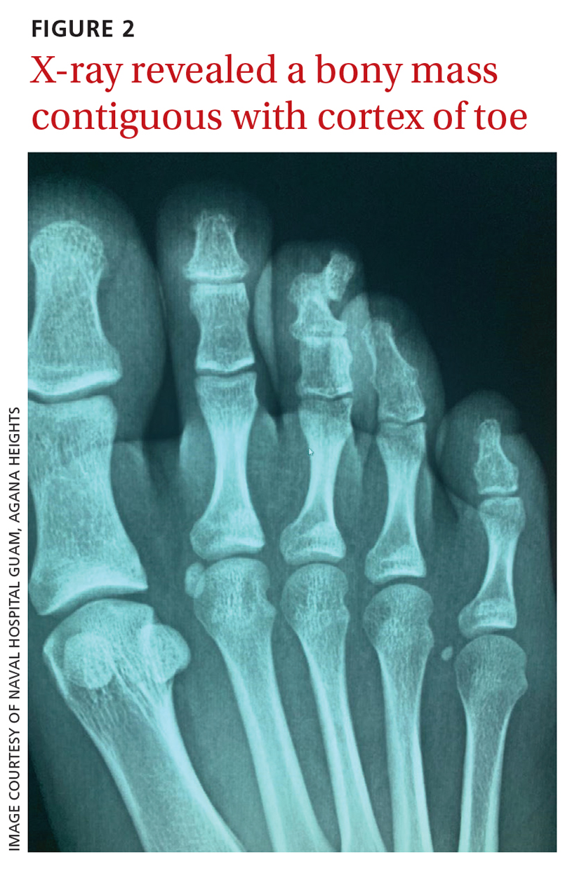 X-ray revealed a bony mass contiguous with cortex of toe