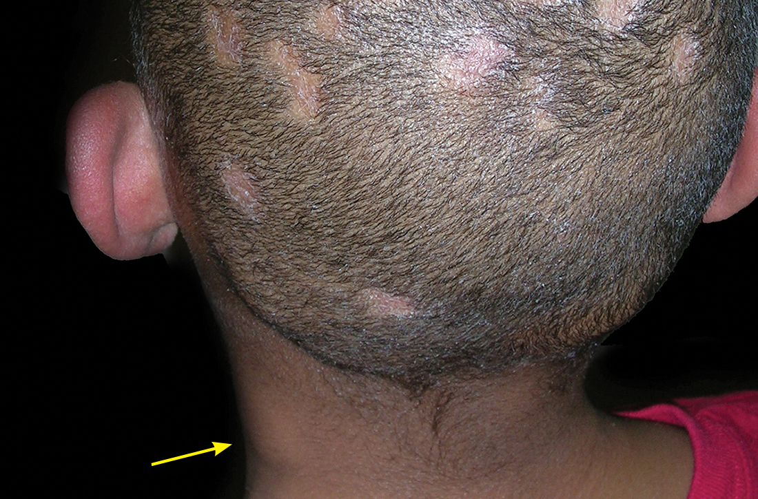 Tinea capitis