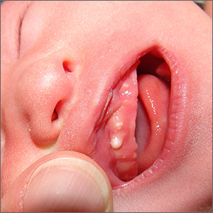 Newborn with white oral lesions