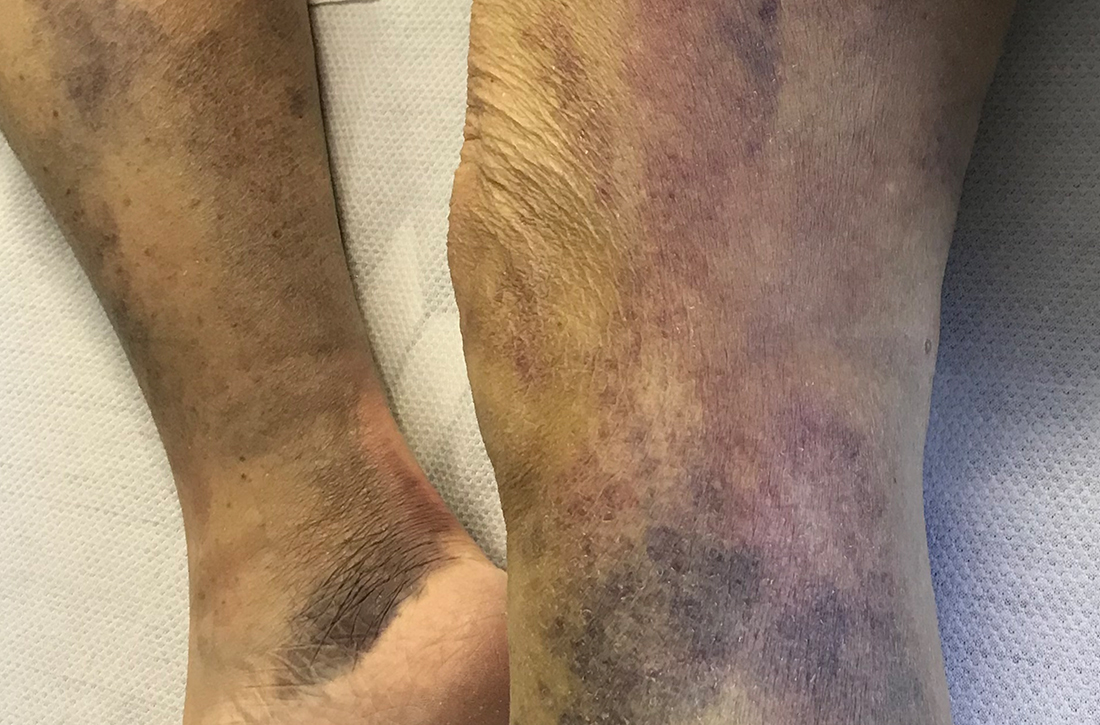 Diffuse ecchymoses and perifollicular, purpuric papules and plaques on legs