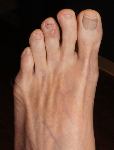 Clear toe lesion