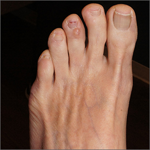 Clear toe lesion