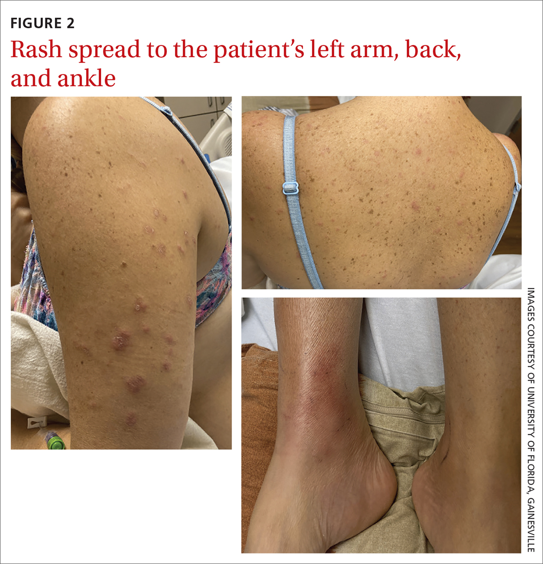 Rash spread to the patient’s left arm, back, and ankle