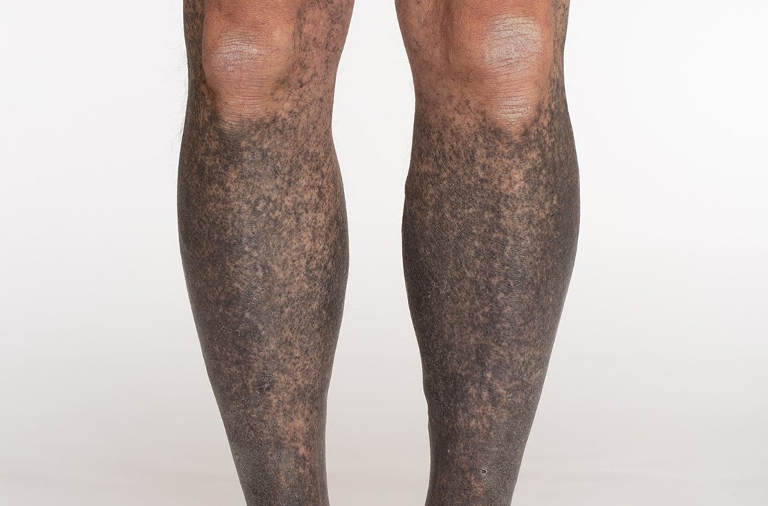 Confluent blue-black hyperpigmentation of the legs