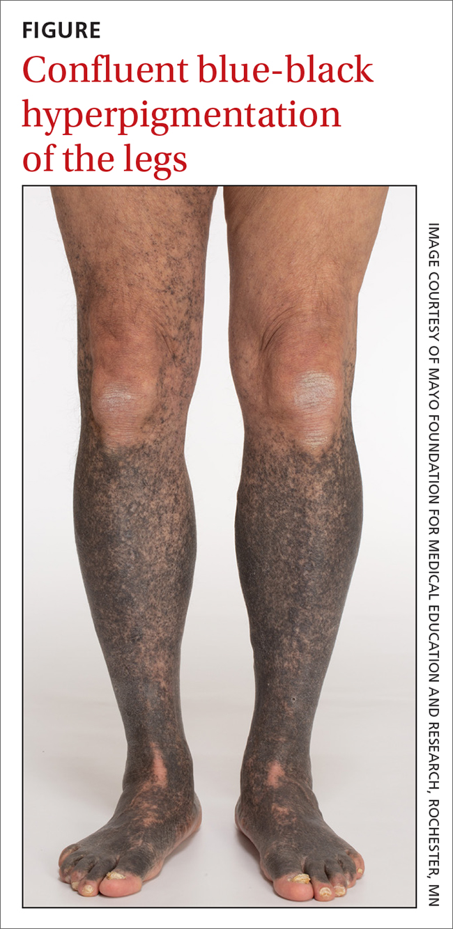 Confluent blue-black hyperpigmentation of the legs