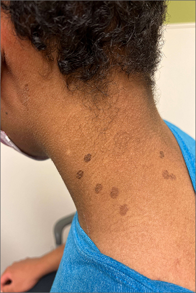 Teen with hyperpigmented skin lesions
