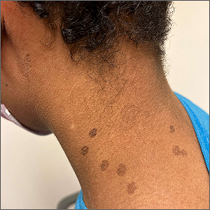 Teen with hyperpigmented skin lesions