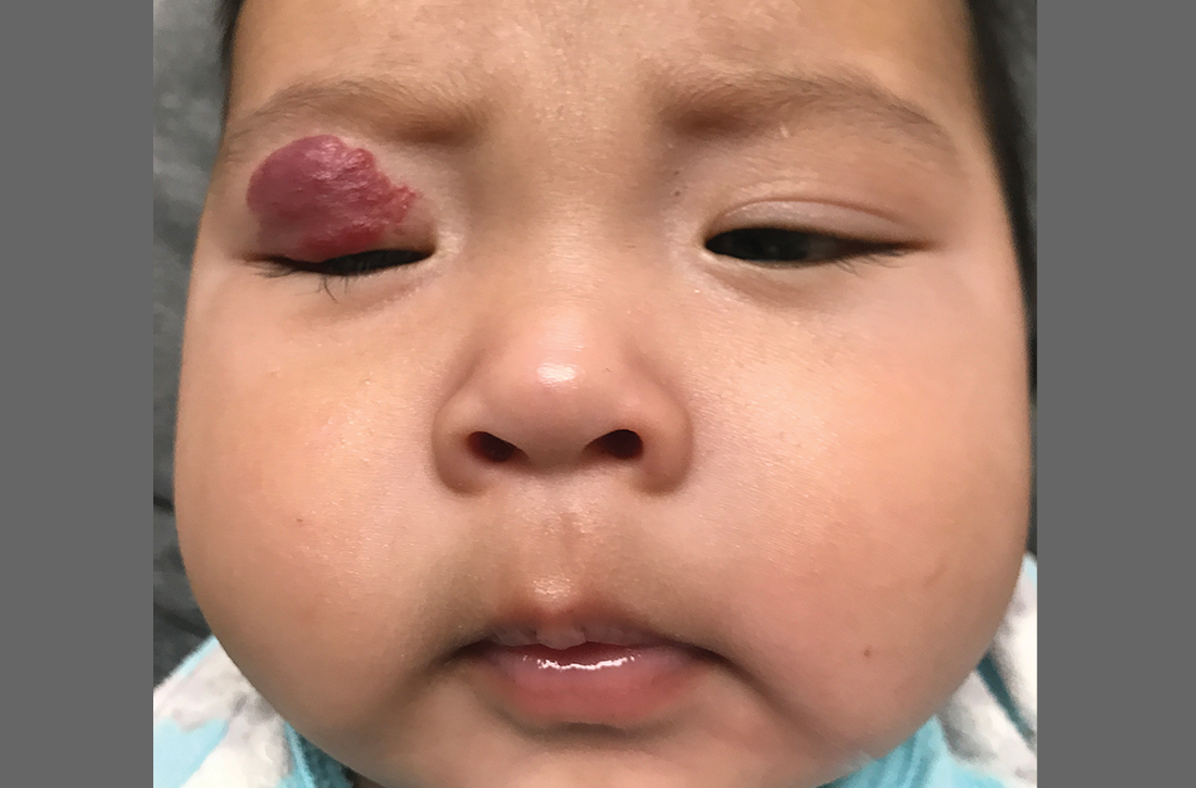 As this 4-month-old infant grew, so did the lesion