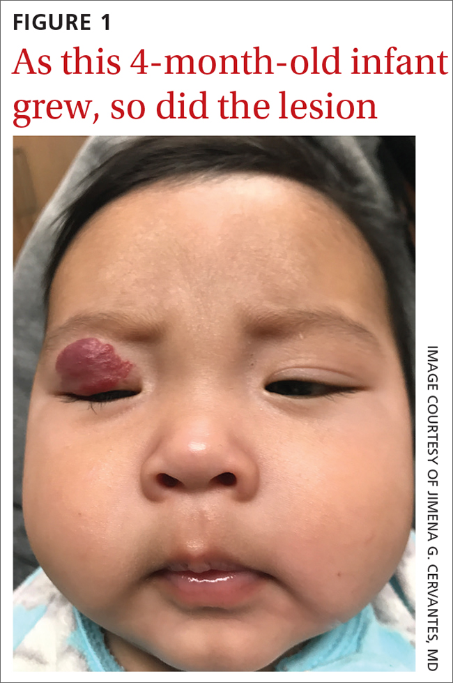 As this 4-month-old infant grew, so did the lesion 