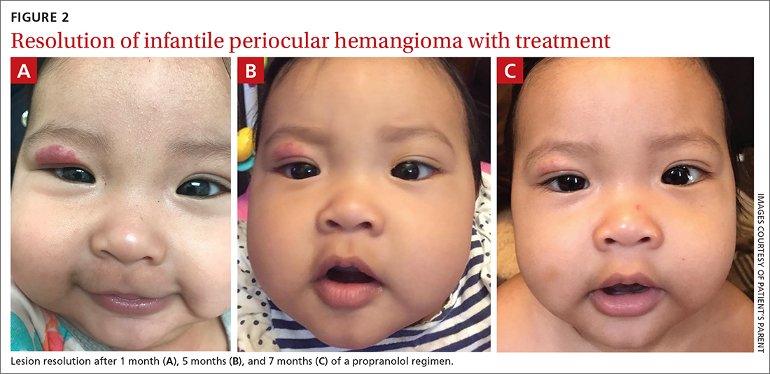 Resolution of infantile periocular hemangioma with treatment