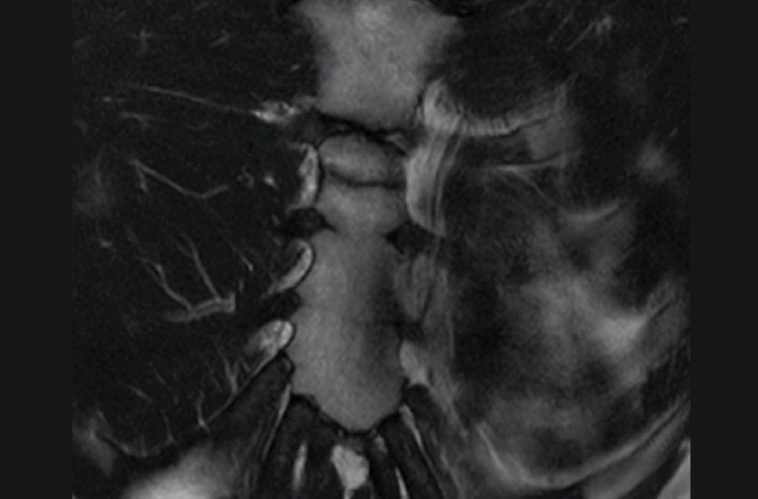 T2-weighted magnetic resonance imaging coronal views identified a transverse, nondisplaced fracture along the superior sternum with surrounding bone marrow edema.