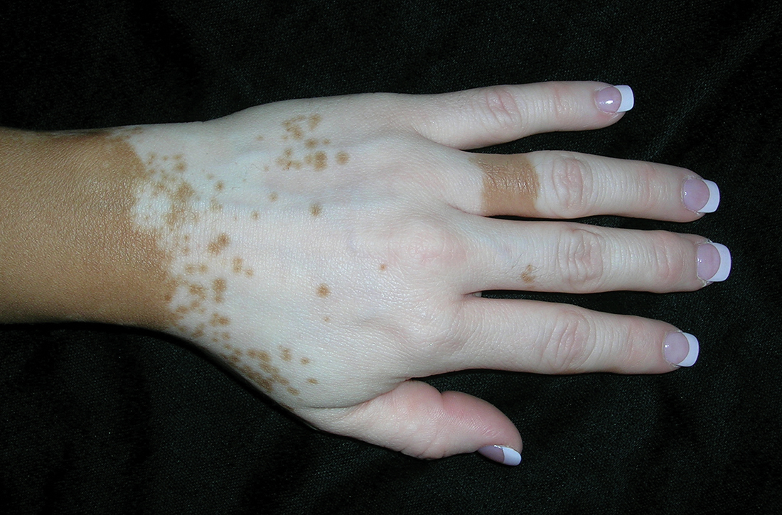 Vitiligo