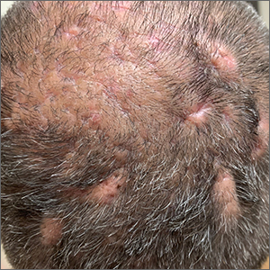 Scalp ridges