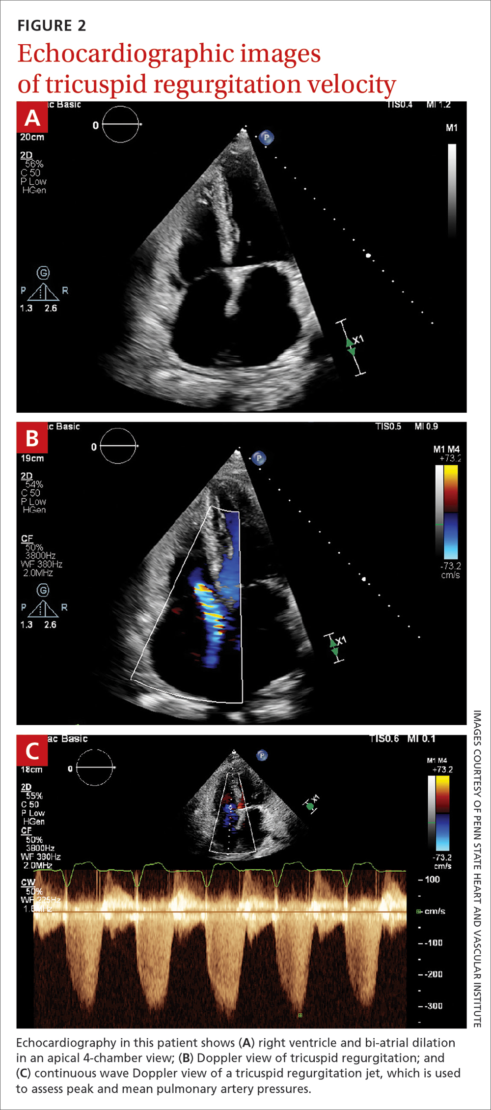 Echocardiographic images of tricuspid regurgitation velocity