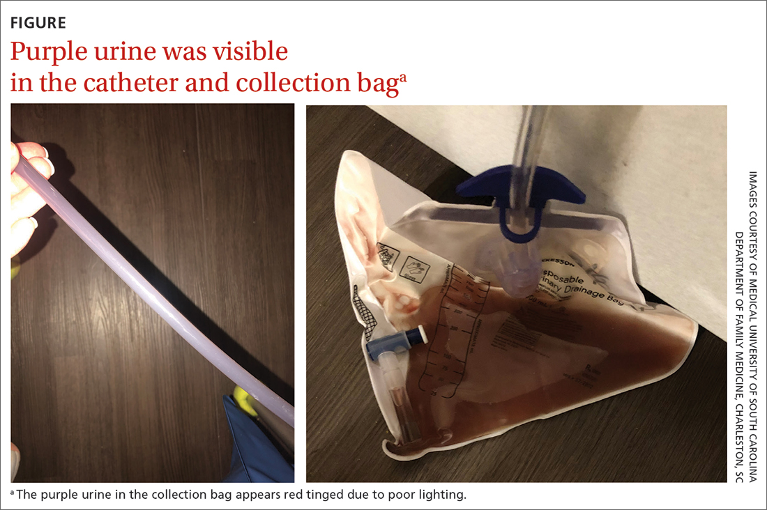 Purple urine was visible in the catheter and collection bag