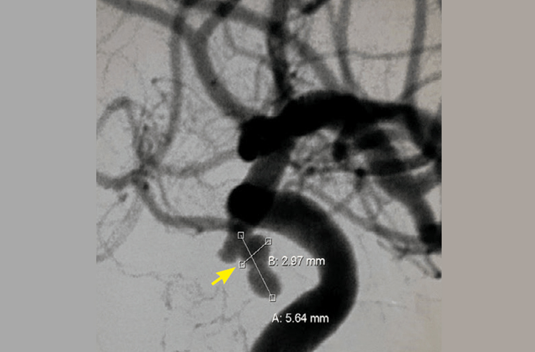 Cerebral angiography showing a posterior communicating artery aneurysm