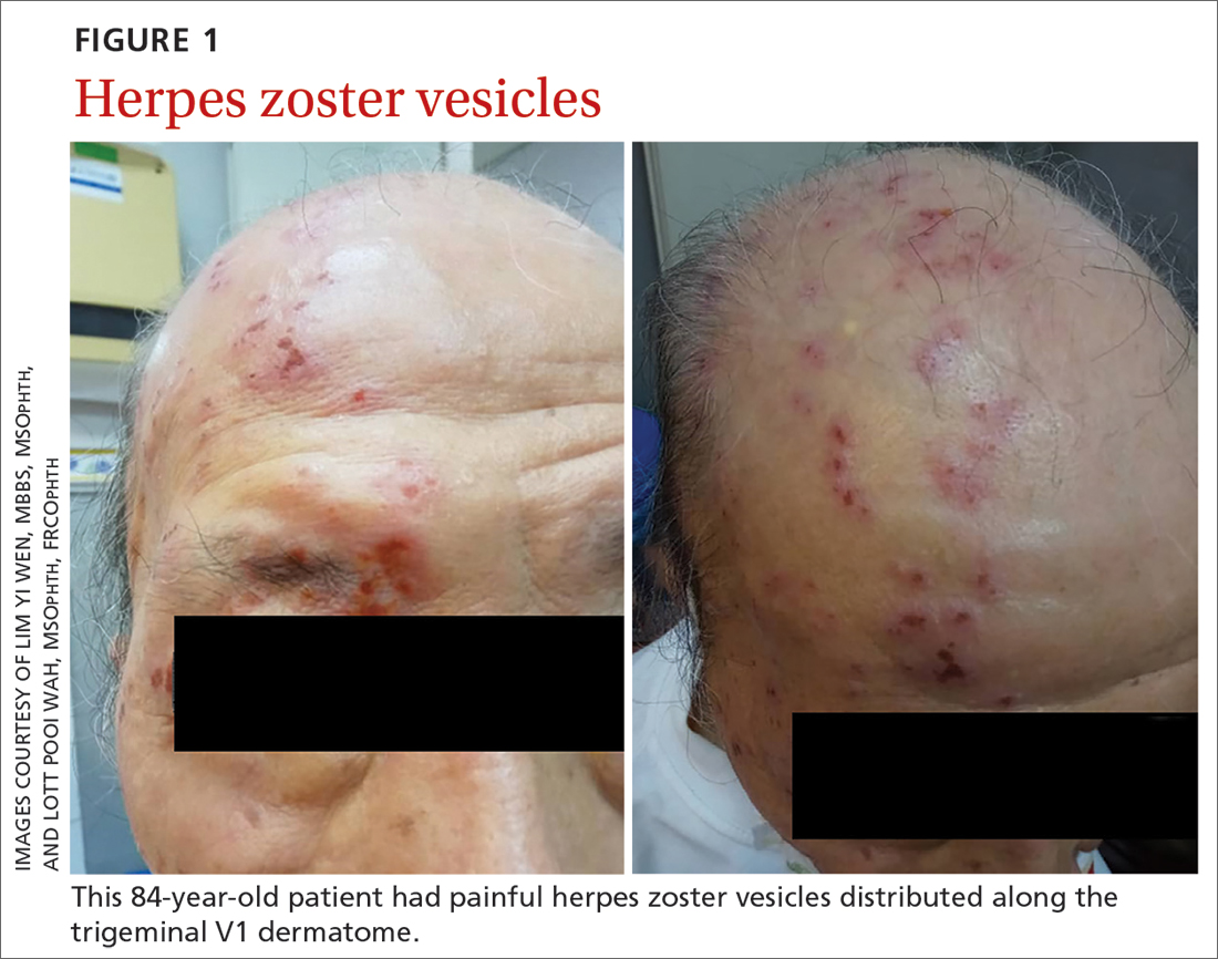 Herpes zoster vesicles
