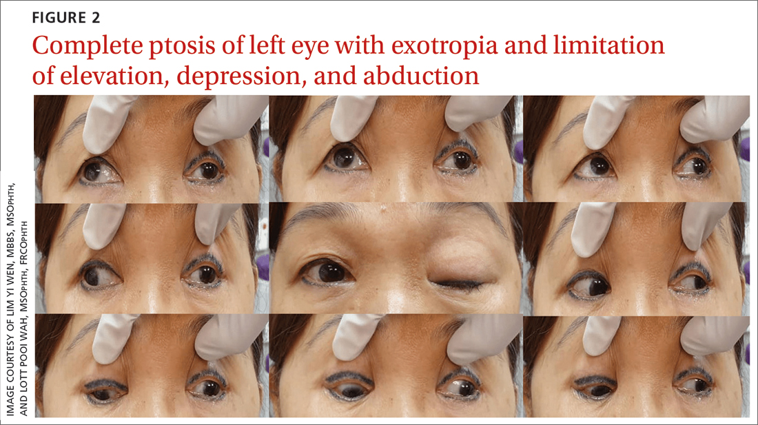 Complete ptosis of left eye with exotropia and limitation of elevation, depression, and abduction