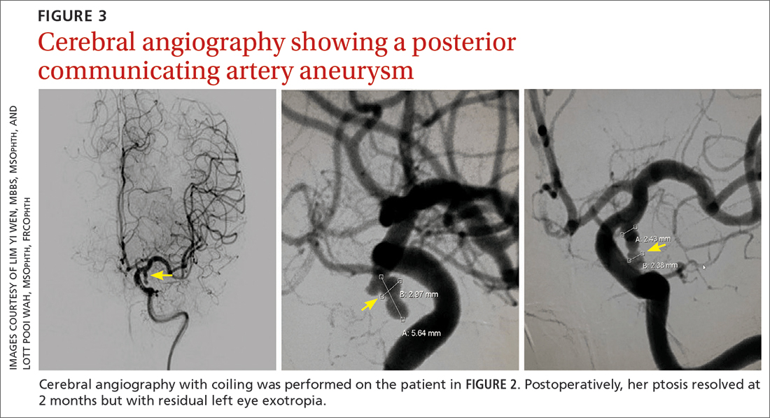 Cerebral angiography showing a posterior communicating artery aneurysm