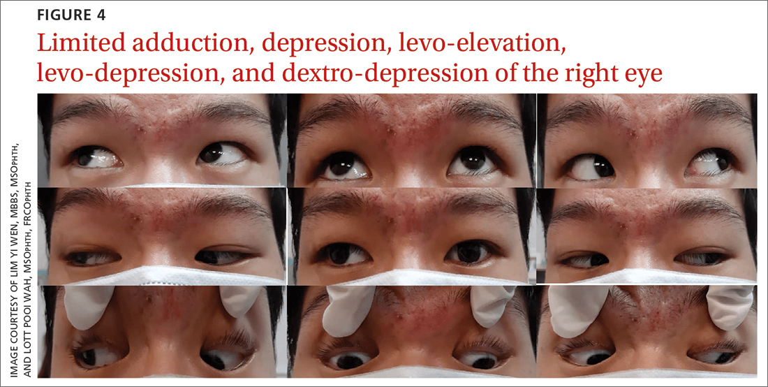 Limited adduction, depression, levo-elevation, levo-depression, and dextro-depression of the right eye