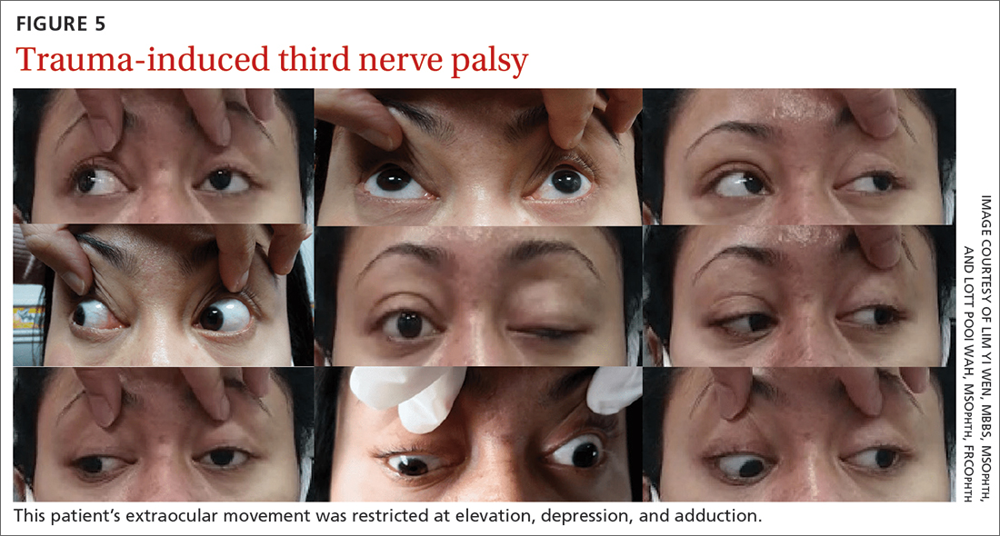 case study of 3rd nerve palsy