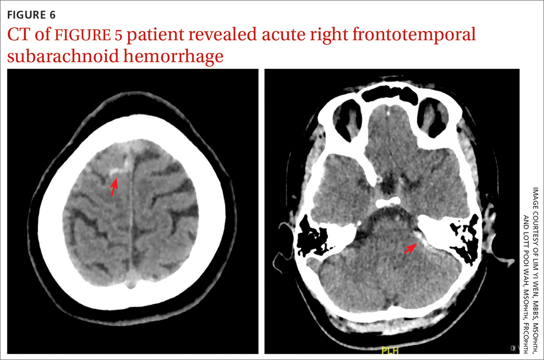 CT of FIGURE 5 patient revealed acute right frontotemporal subarachnoid hemorrhage 