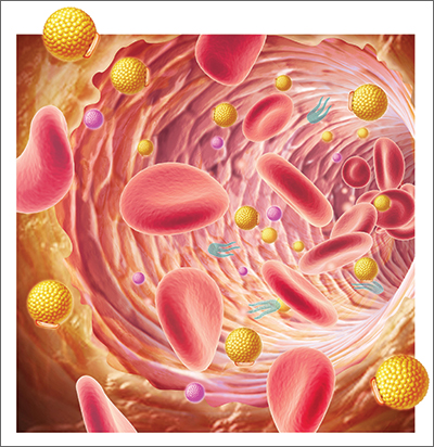 Hyperlipidemia