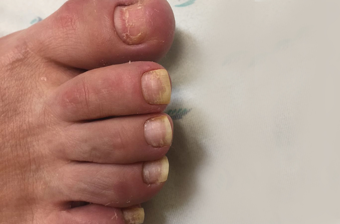 Nails became discolored and fell off after Dx of hand-foot-mouth disease