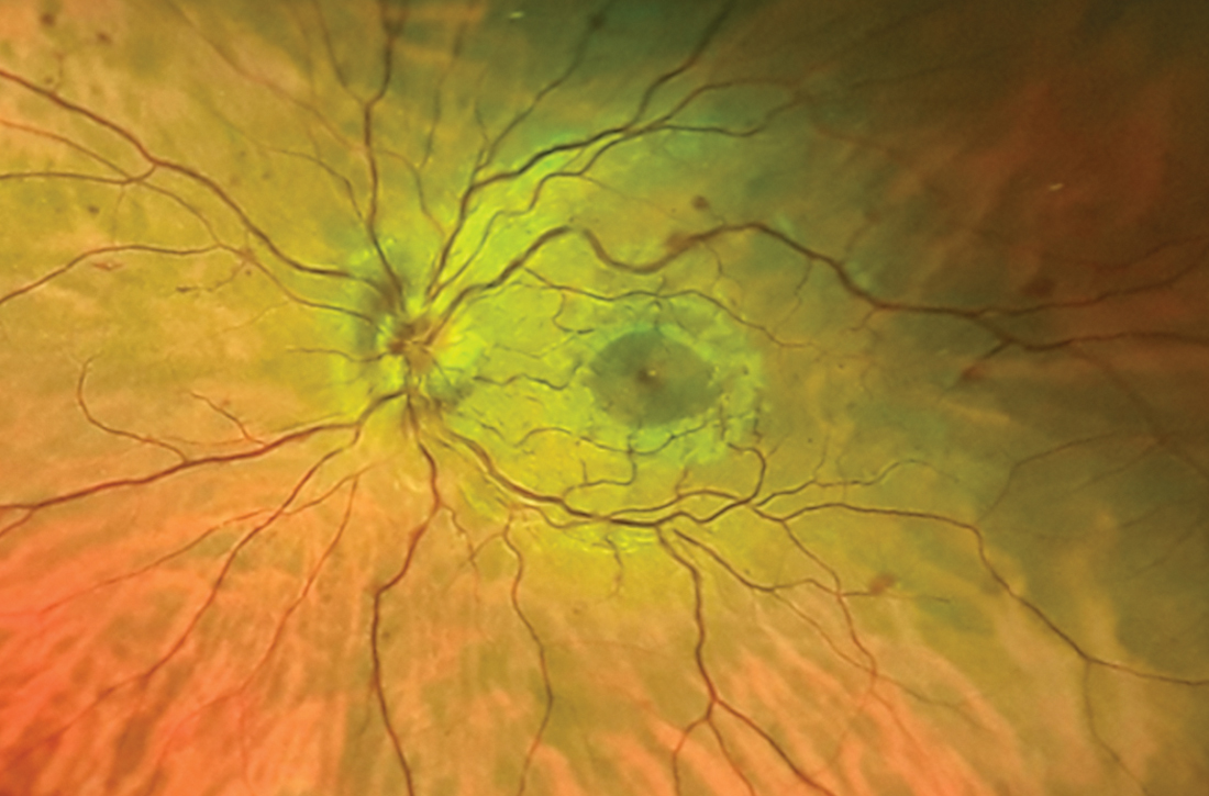 Funduscopic exam shows the unaffected right eye with edema of the optic cup, tortuous vasculature, and microhemorrhages.