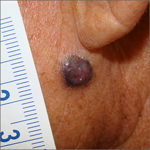 Dark facial lesion