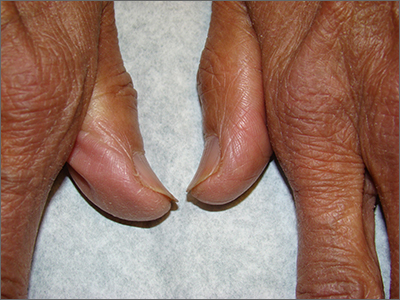 Mayo Clinic Q and A: Treatment for toenail fungus isn't always necessary -  Mayo Clinic News Network