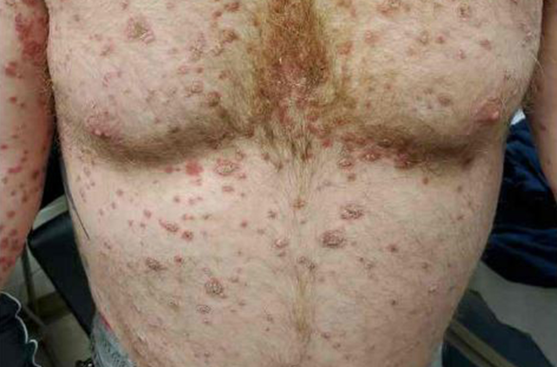 Rash covered up to 70% of the patient’s total body surface area 