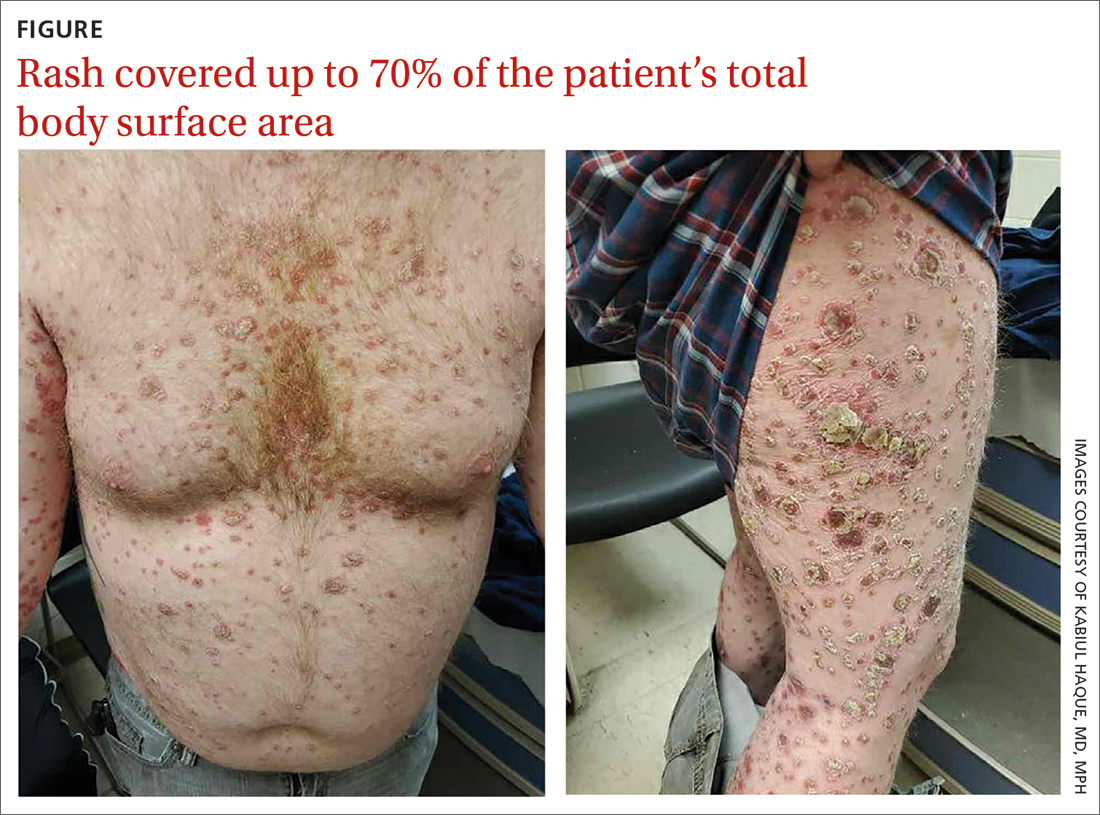 Rash covered up to 70% of the patient’s total body surface area