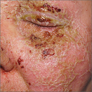 Pustules on face