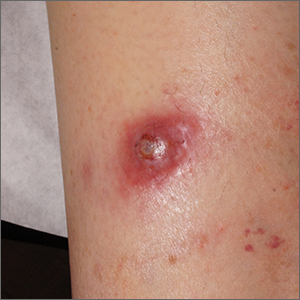 Firm nodule following tick bite