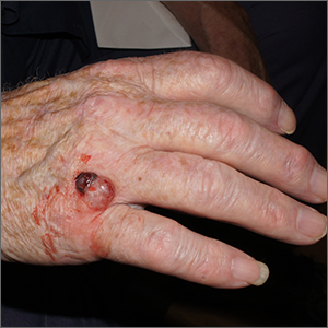 Nodule on farmer’s hand