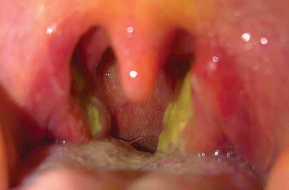 Bilateral tonsillar exudates with pharyngeal erythema