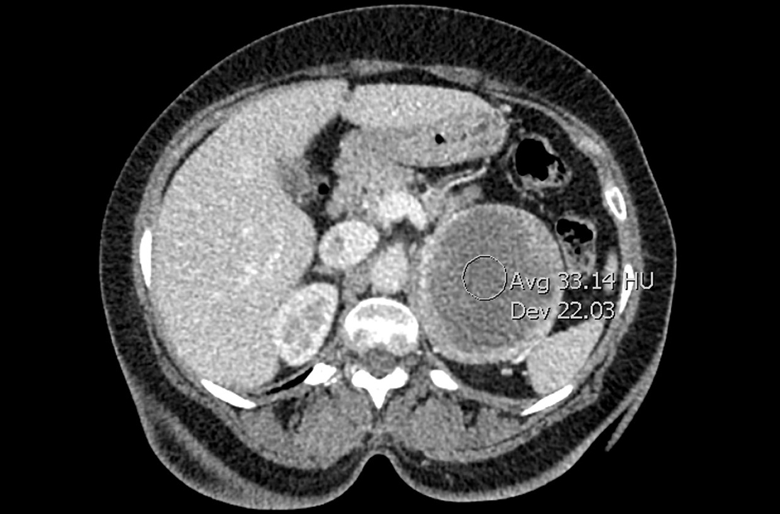 Computed tomography revealed a mass in the left adrenal gland