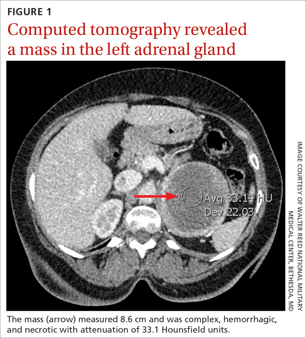 Computed tomography revealed a mass in the left adrenal gland